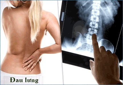 Thuốc đông y gia truyền chữa bách bệnh đau lưng